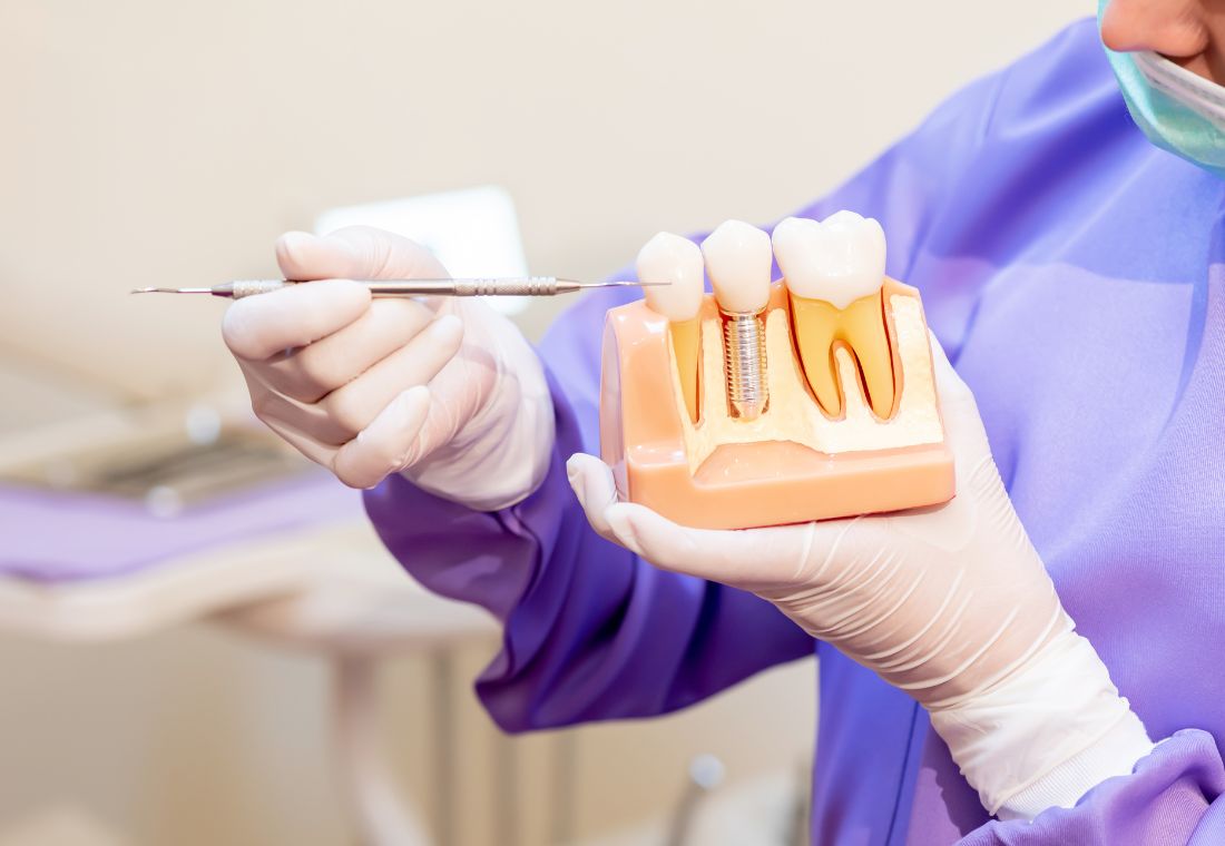 ¿Cómo funcionan los implantes dentales?