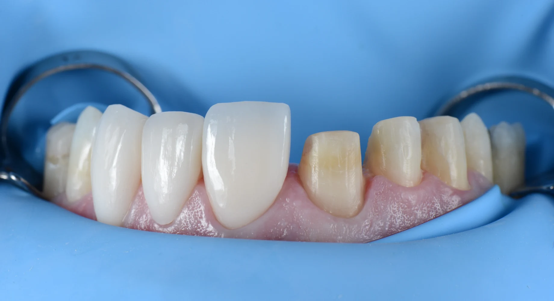 ¿Qué son las carillas?