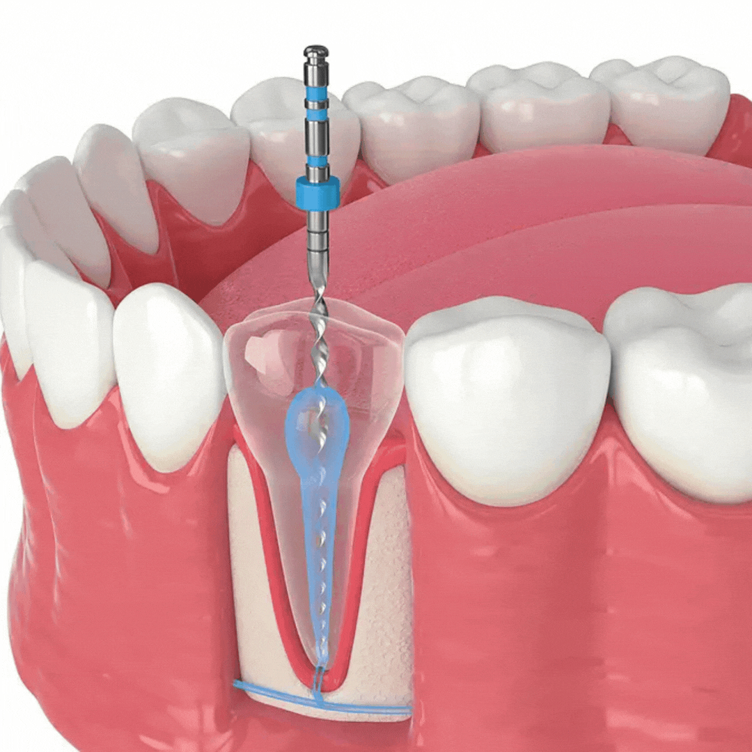 ¿Cuándo es necesario un tratamiento de conducto?