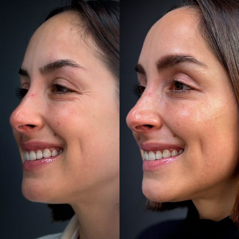 Resultados de Botox 3 zonas