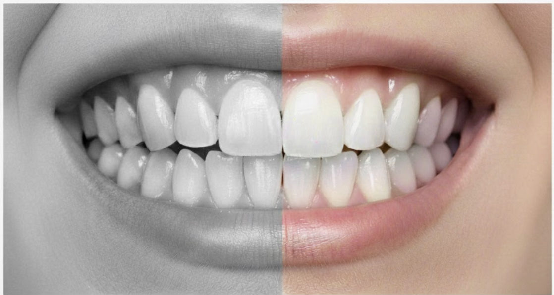 ORTODONCIA INVISIBLE