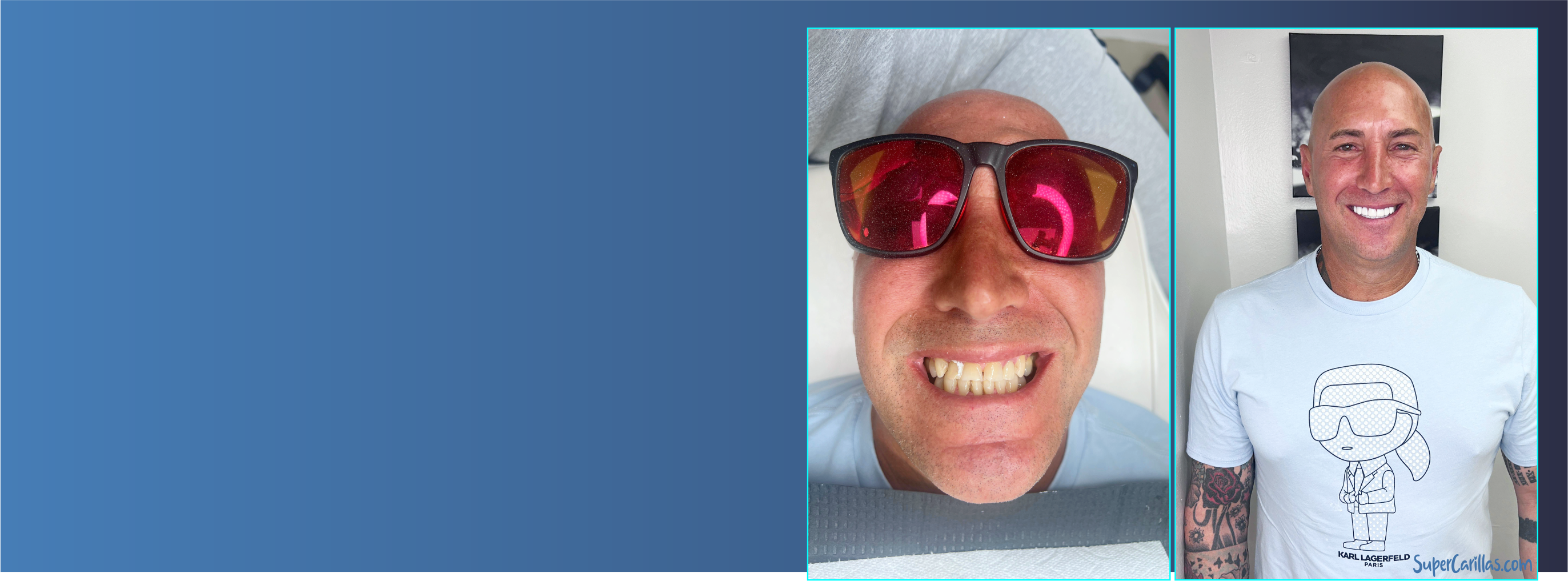 CARILLAS RESINA / VENEERS COMPOSITE