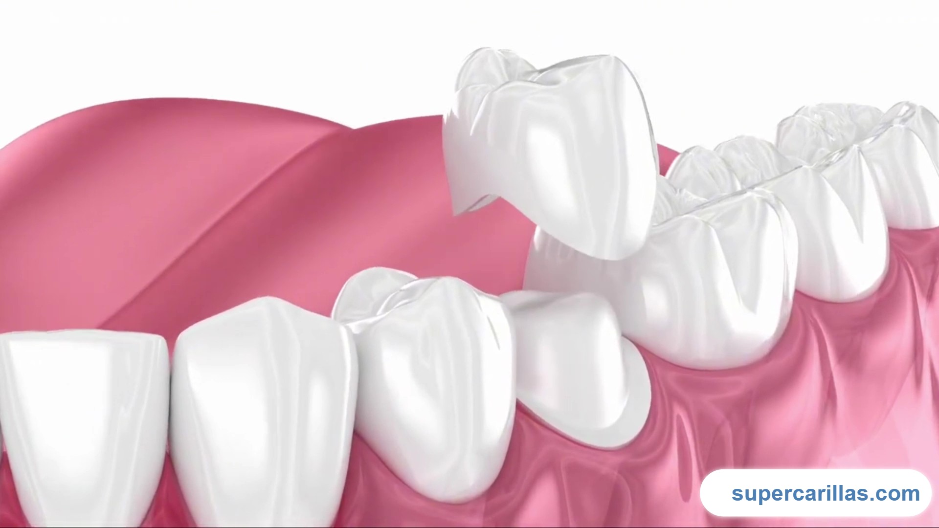 Una corona dental es una funda en forma de diente que se coloca sobre un diente dañado, débil o desgastado para restaurar su forma, función y apariencia. Se fabrican en porcelana cerámica, y son una solución permanente que puede durar entre 10 y 15 años con el cuidado adecuado.