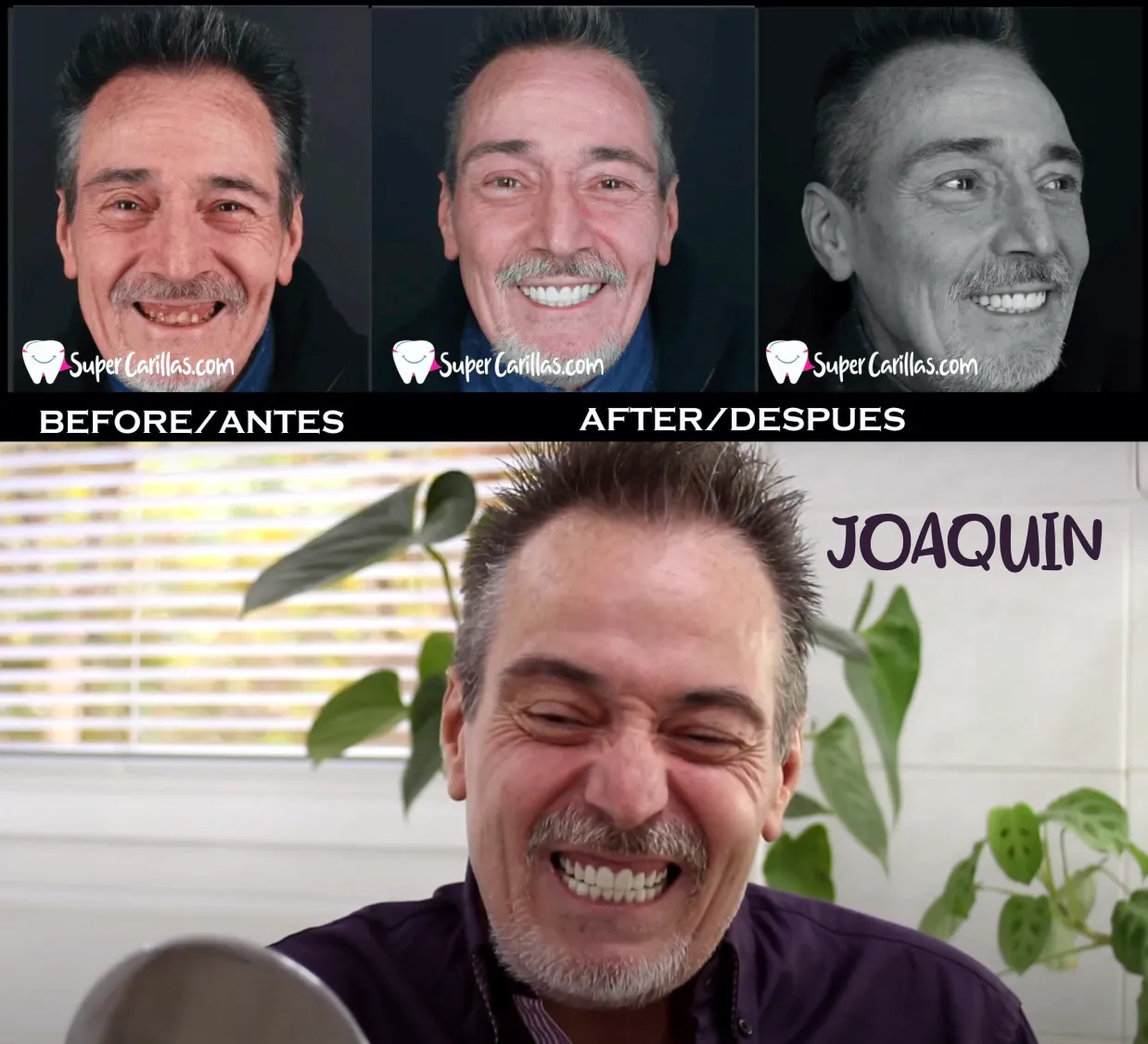Carillas dentales en resina y porcelana – Antes y después de sonrisa perfecta en SuperCarillas Miami y Orlando