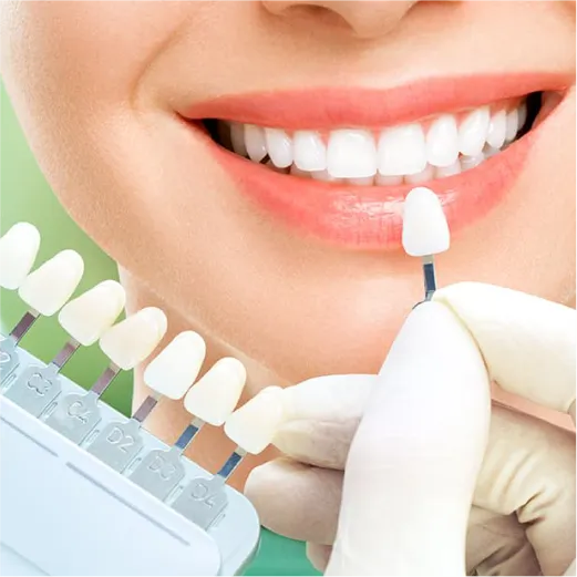 Antes y después de carillas dentales en Miami con SuperCarillas — transformación real de sonrisa: dientes manchados y desgastados antes, blancos y alineados después.