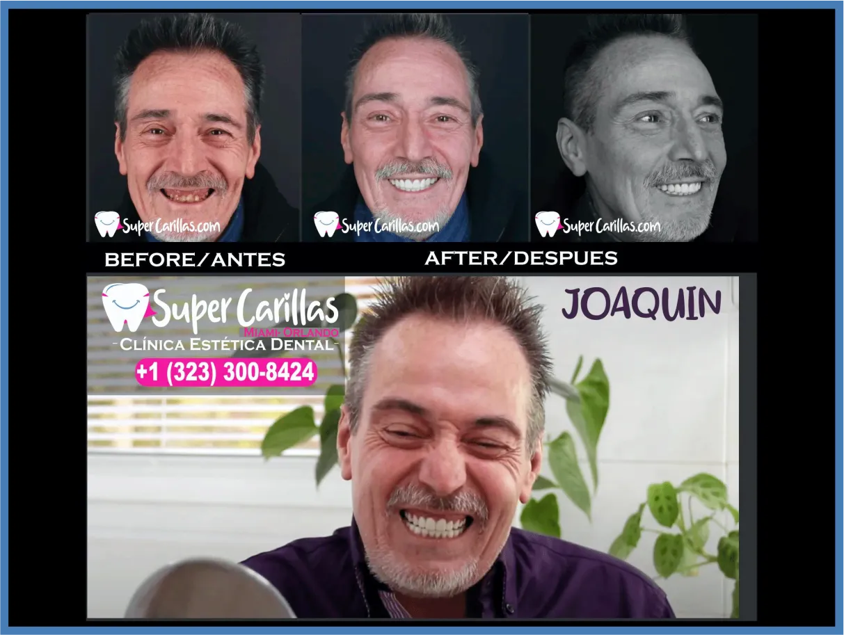 Carillas dentales en resina y porcelana – Antes y después de sonrisa perfecta en SuperCarillas Miami y Orlando