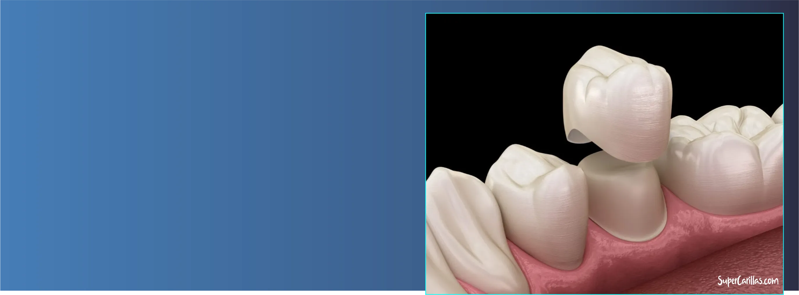 corona dental porcelana miami