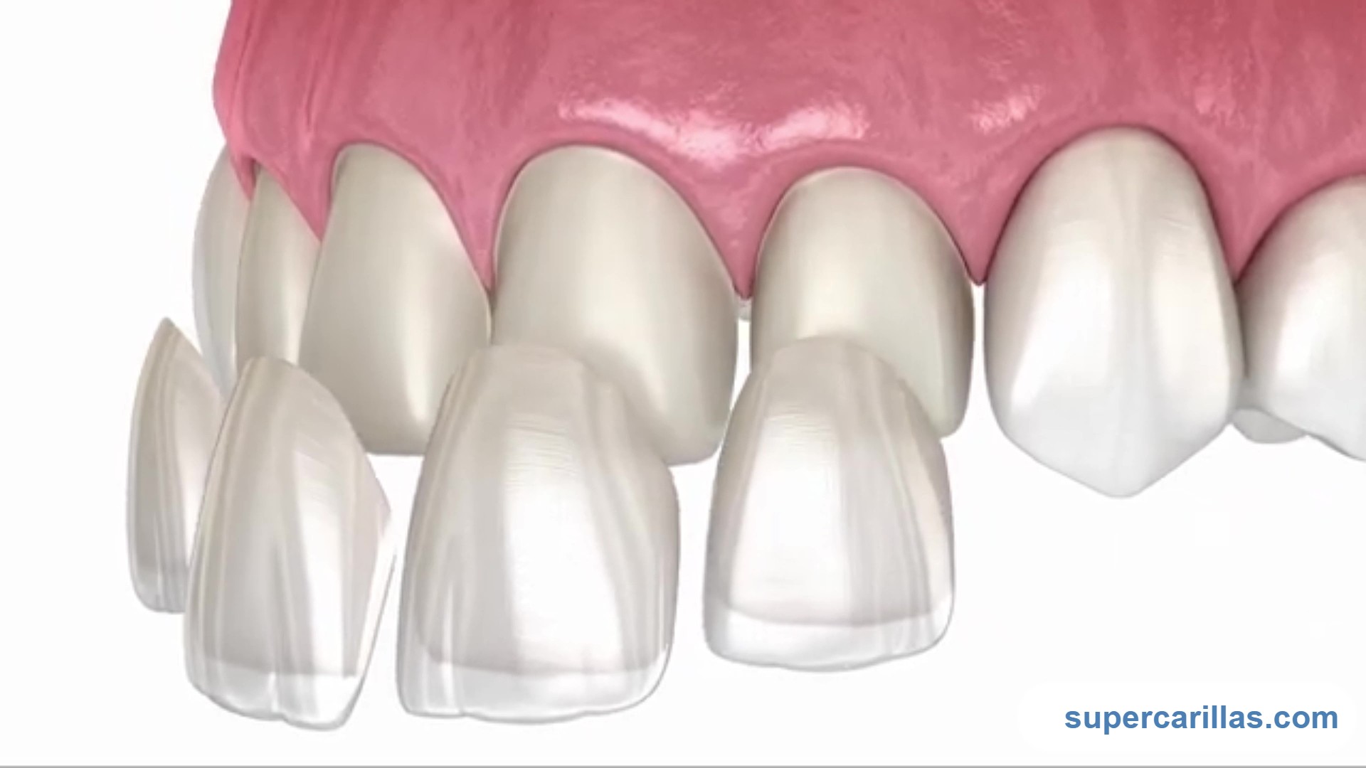 Los diseños de sonrisa con carillas estratificadas son finas láminas de cerámica porcelana (composite) que se aplican sobre la superficie de los dientes para mejorar su apariencia estética.