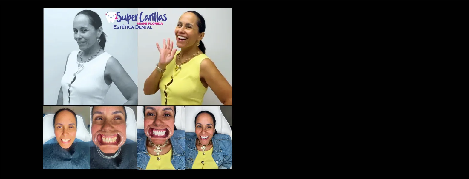 20 carillas porcelana $4.990 <br>20 carillas resina $1.590