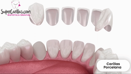 Especialistas en Carillas Dentales de Porcelana y Resina