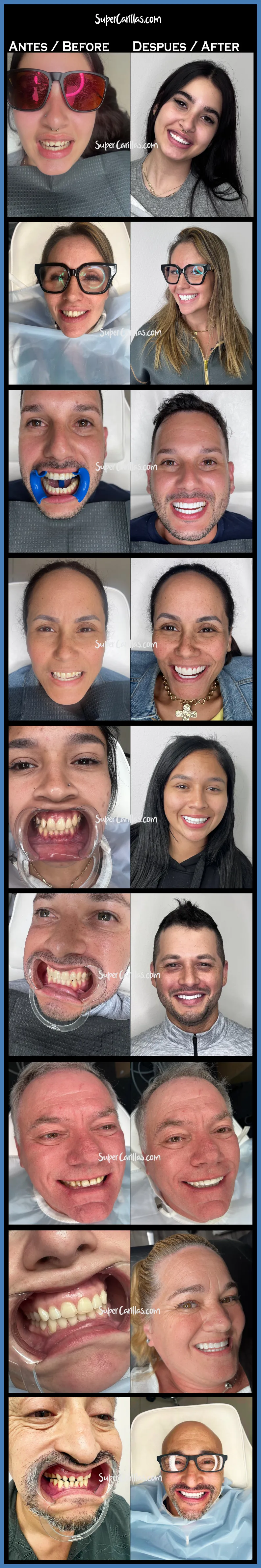 imagenes de pacientes con carillas dentales antes y después 