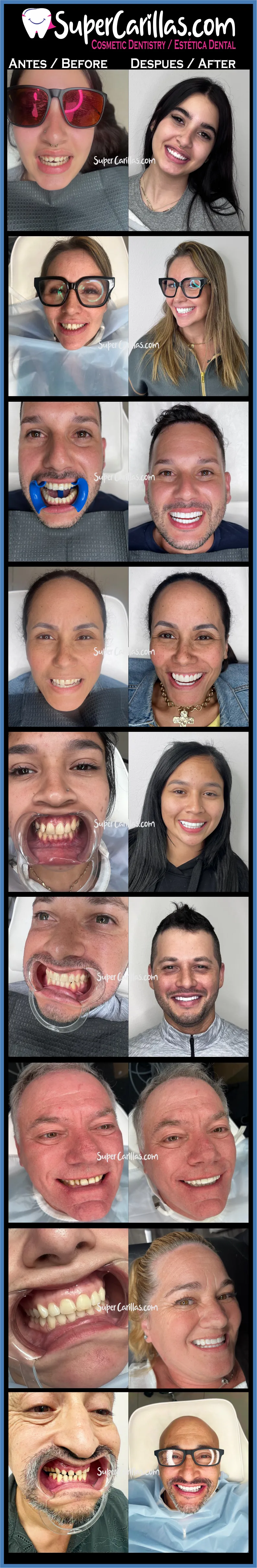 images of patients with dental veneers before and after 