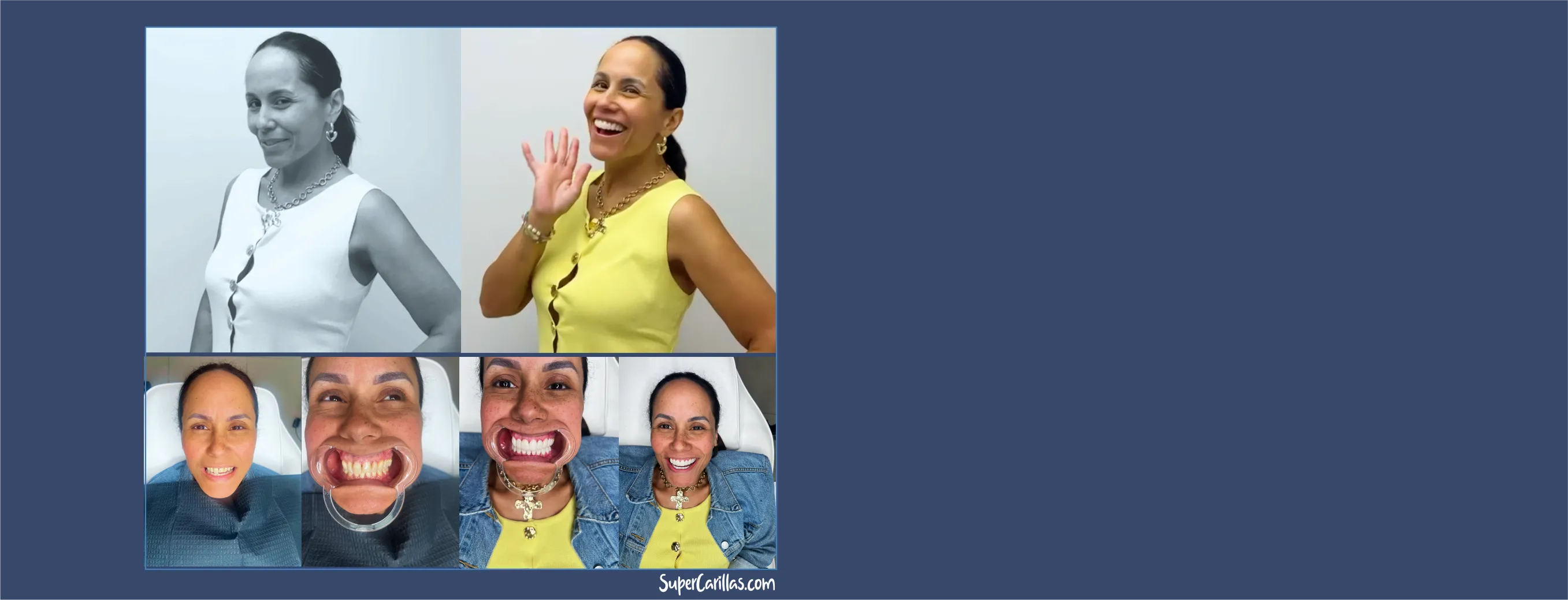 Antes y después de carillas dentales estéticas en Miami