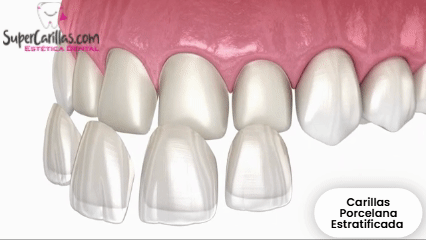 Carillas Porcelana Estratificadas Precio $6.490 (Durabilidad 20 años)