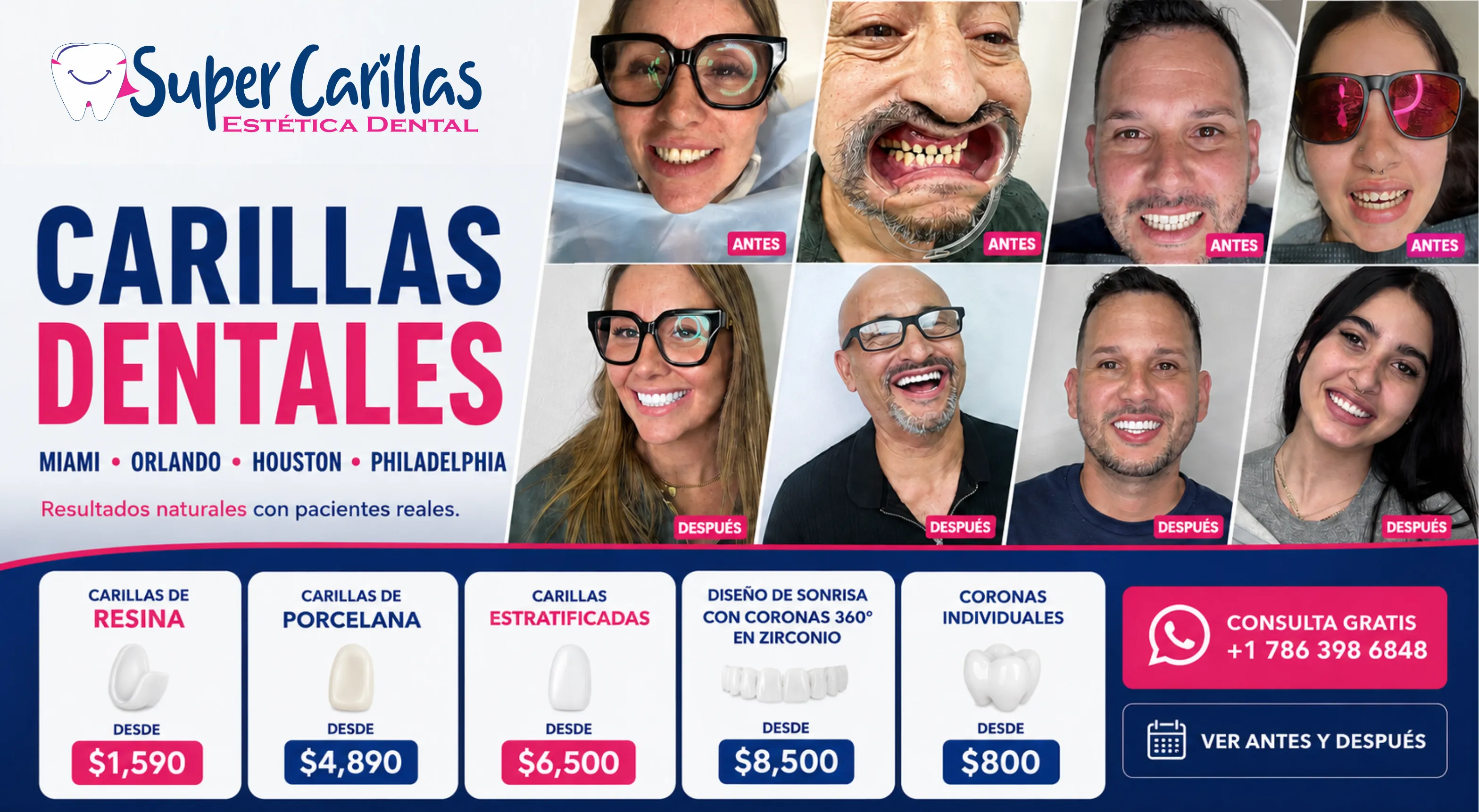 Antes y después de carillas dentales en pacientes reales. Carillas de resina, porcelana y diseño de sonrisa en Miami, Orlando, Houston y Philadelphia por SuperCarillas Estética Dental