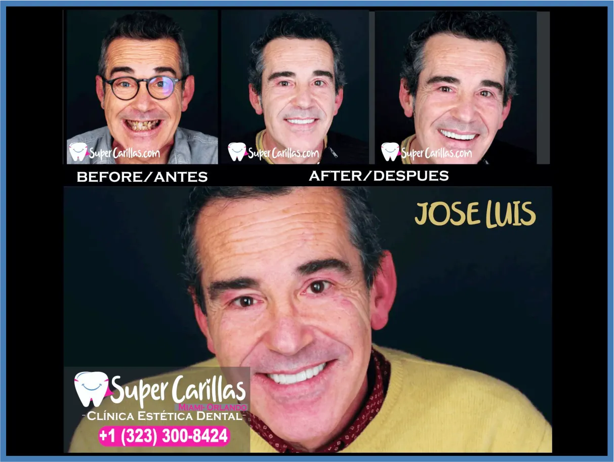 Transformación de sonrisa con carillas dentales en Orlando – Resultados reales de SuperCarillas antes y después