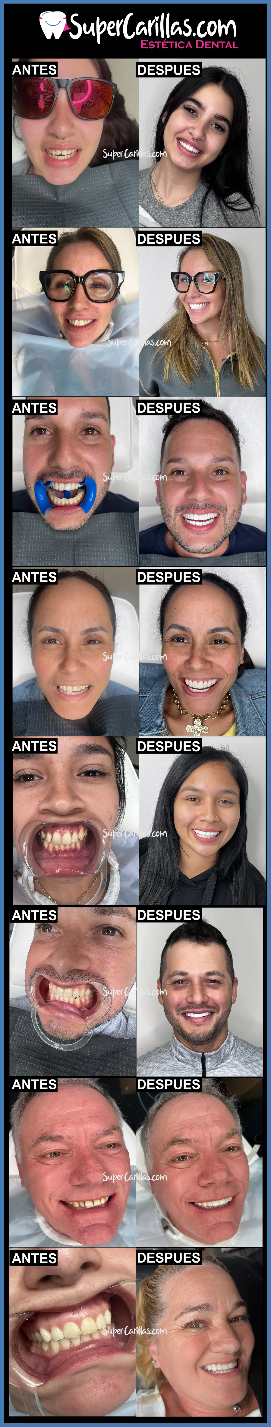 imagenes de pacientes con carillas dentales antes y después 