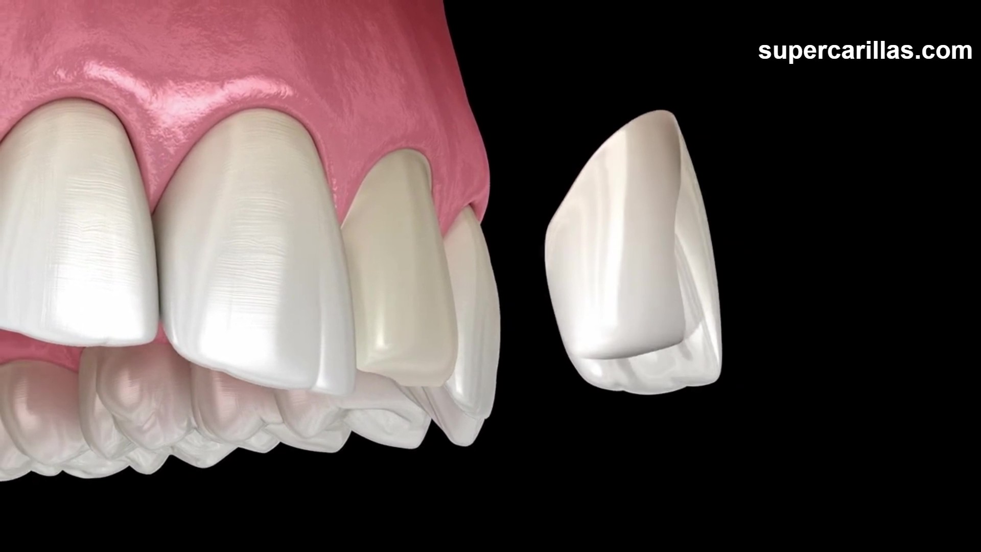 Carillas dentales en resina indirecta con acabado de laboratorio
