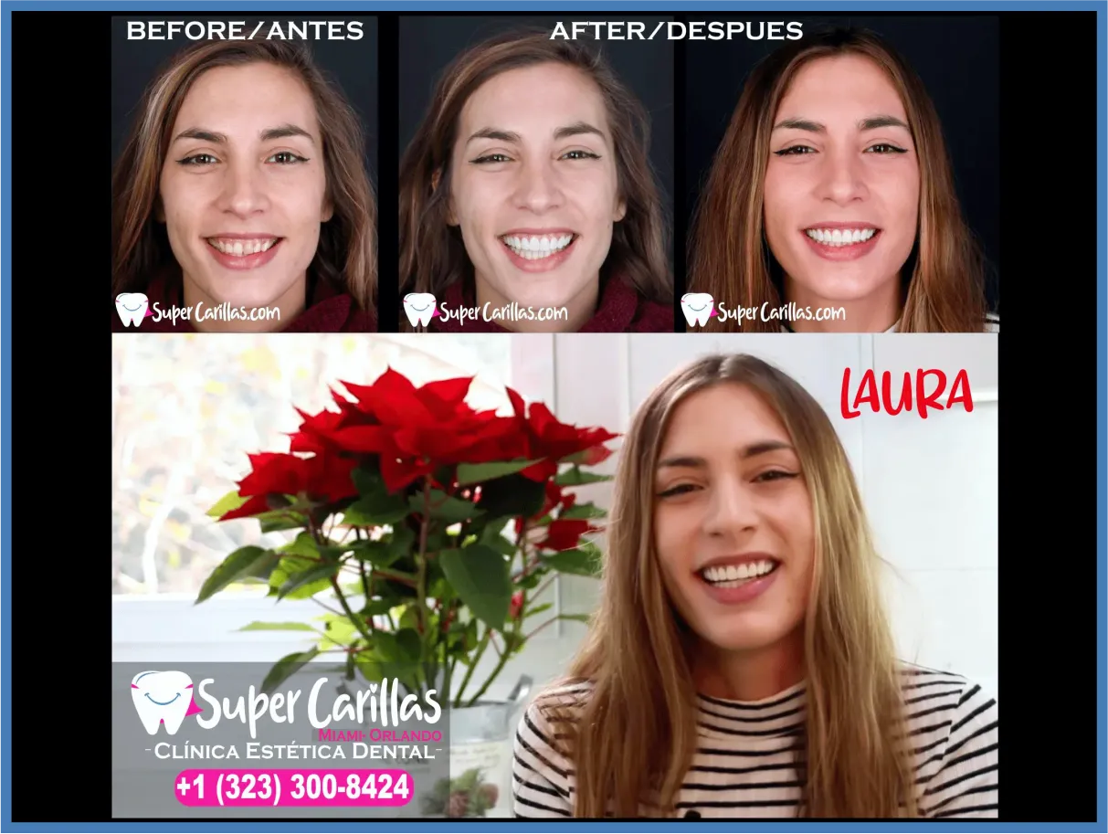 Antes y después de carillas dentales en Miami – Sonrisa transformada con carillas de porcelana de SuperCarillas