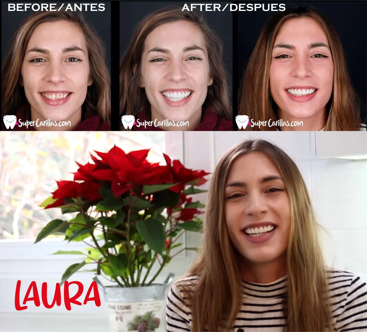 Antes y después de carillas dentales en Miami – Sonrisa transformada con carillas de porcelana de SuperCarillas