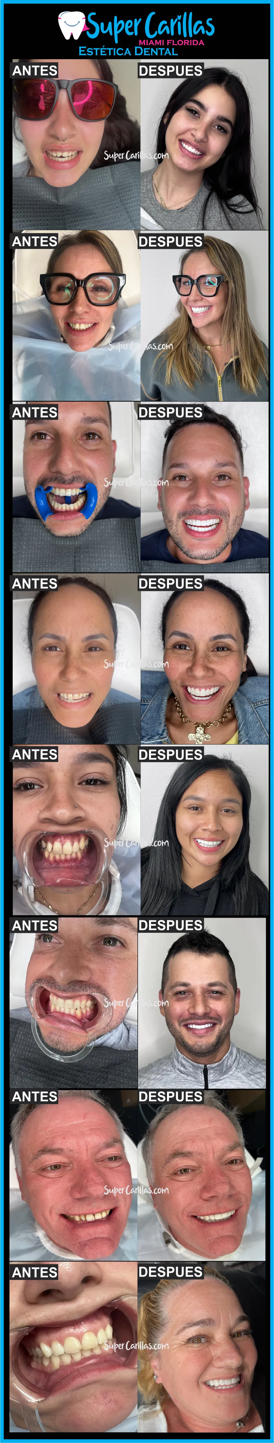 Especialistas en Carillas Dentales de Porcelana y Resina