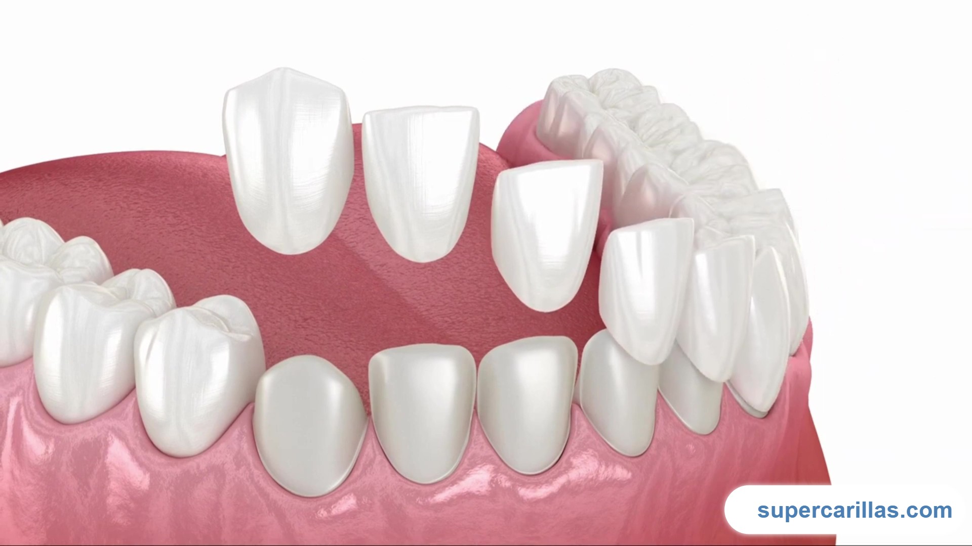 diseños de sonrisa con carillas de porcelana 