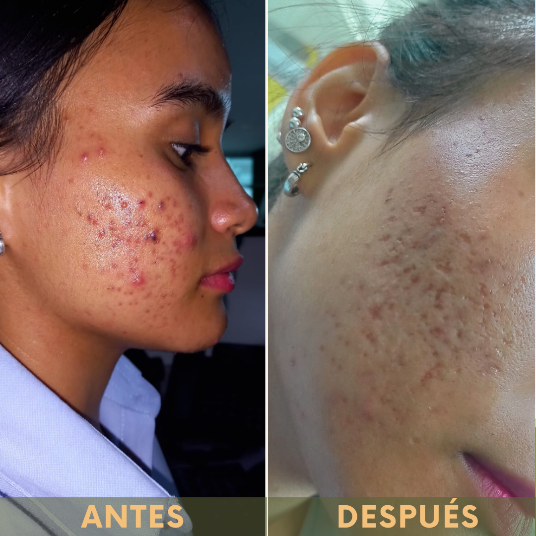 Mejora la apariencia del acné