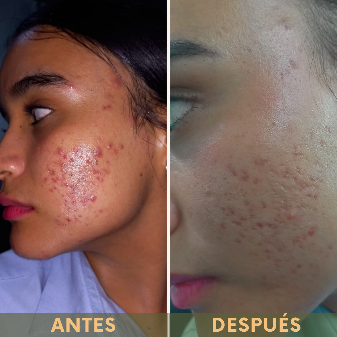Mejora la apariencia del acné