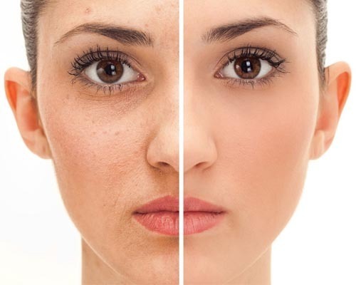 MESOTERAPIA (VITAMINAS FACIALES)