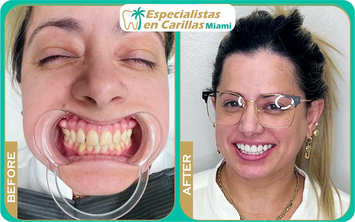 Before and after dental veneers Miami