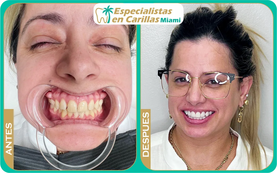 carillas en resina de alta estética 