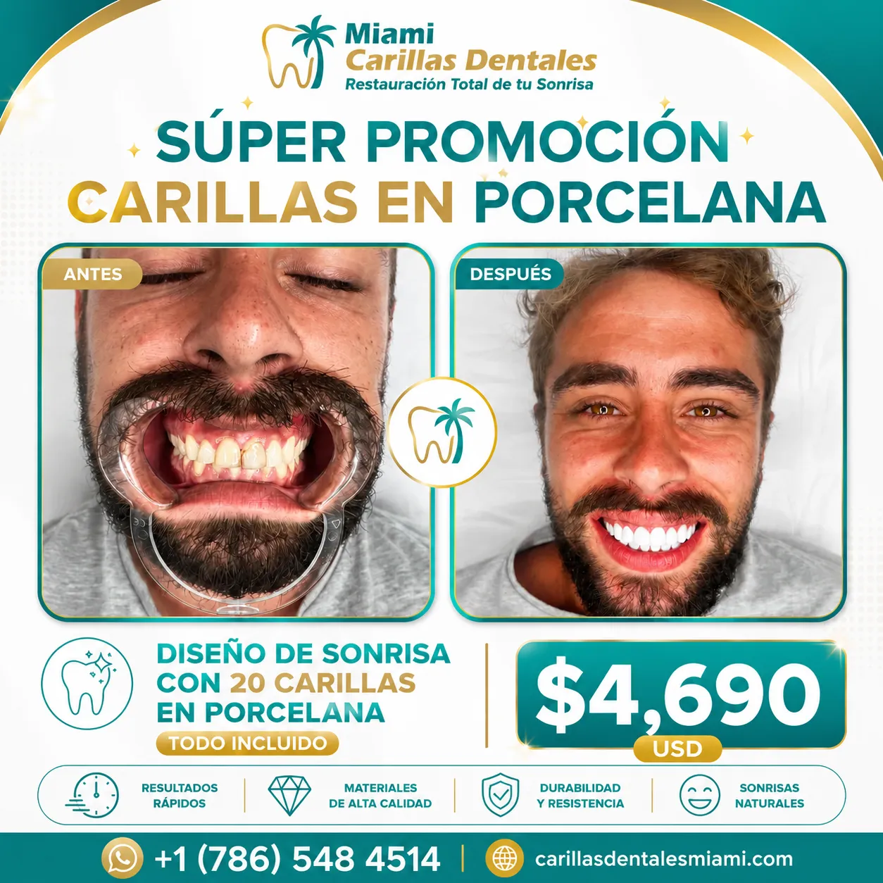 carillas en porcelana miami $4,690