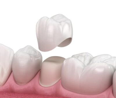 Antes y después de coronas dentales en molares para reparar muelas fracturadas, desgastadas o debilitadas.