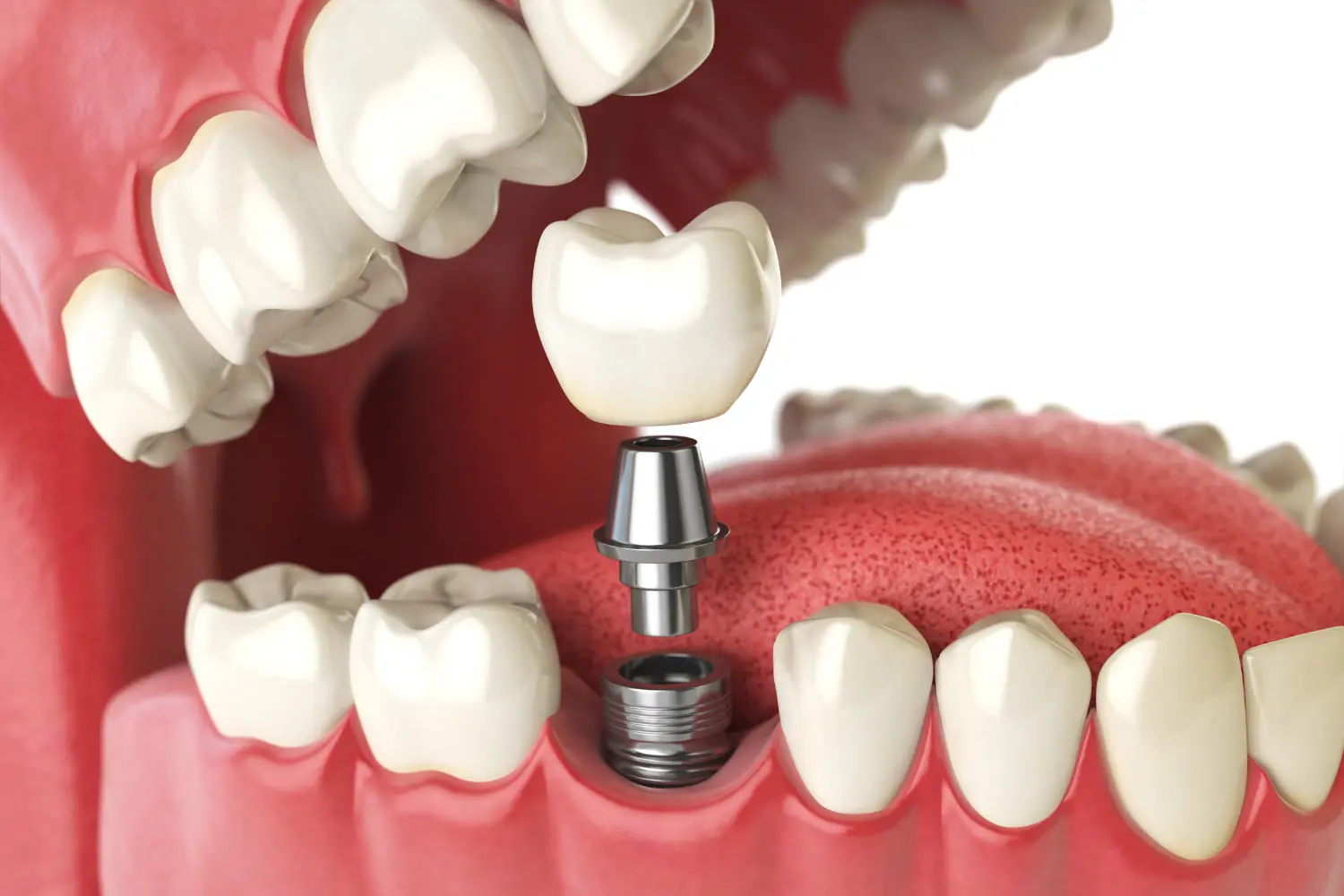 Antes y después de implantes dentales en Miami para restaurar dientes perdidos y recuperar una sonrisa completa.