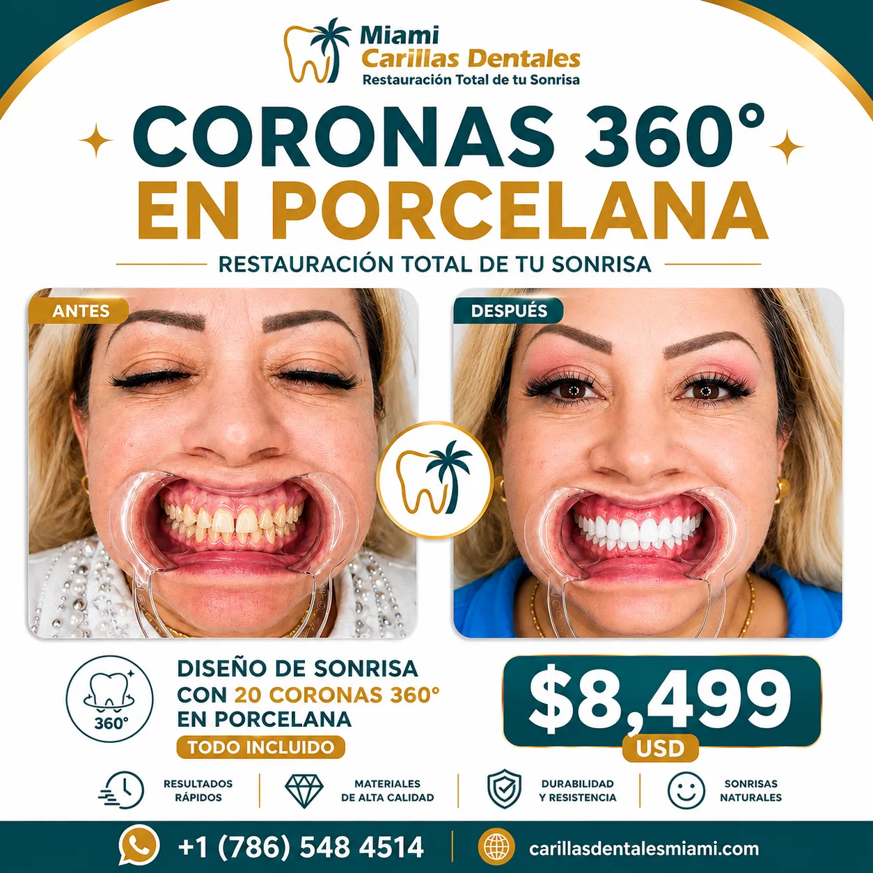 carillas con coronas 360° miami $8,499