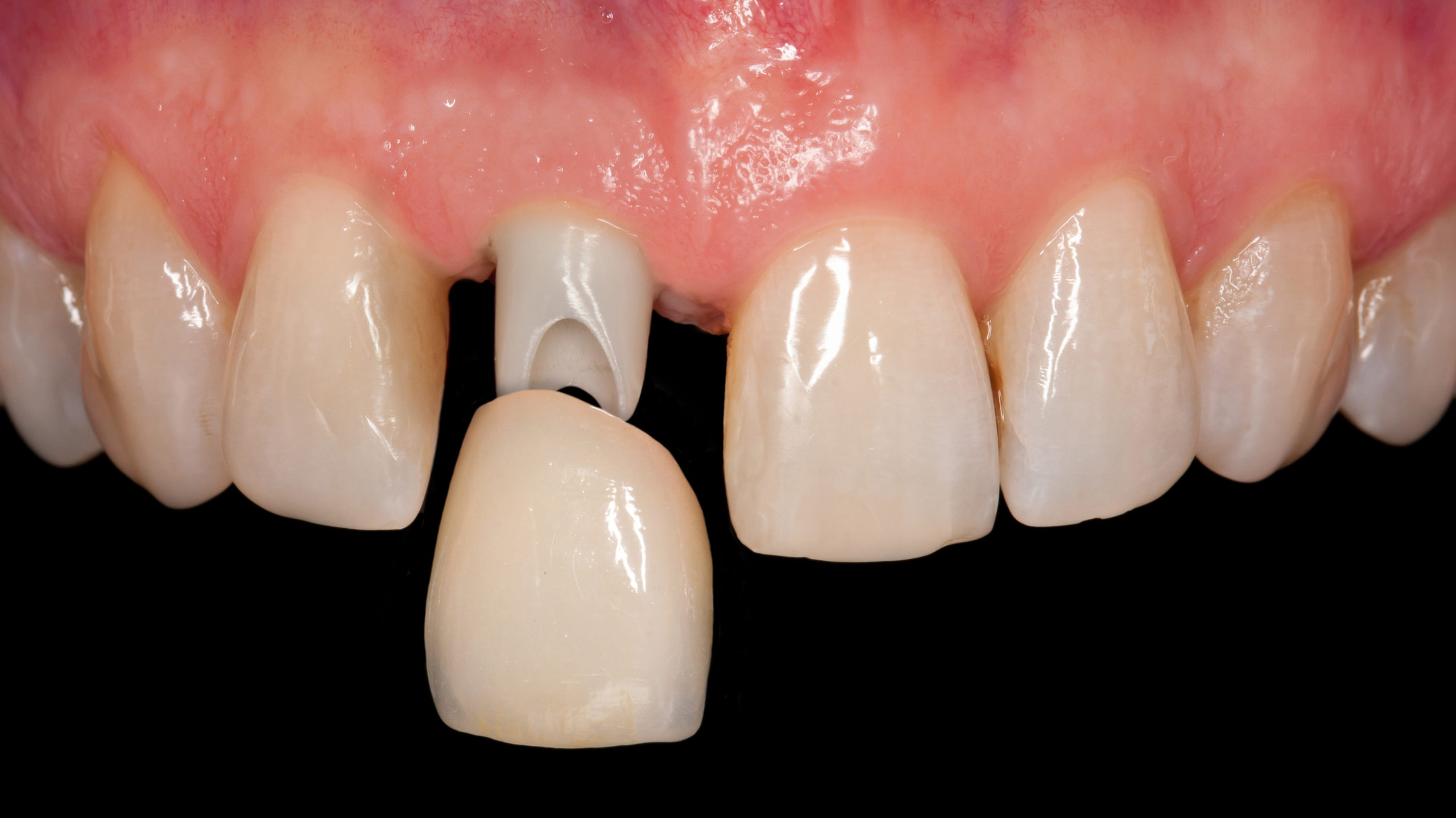 Antes y después de coronas dentales en incisivos frontales para recuperar una sonrisa natural y estética.